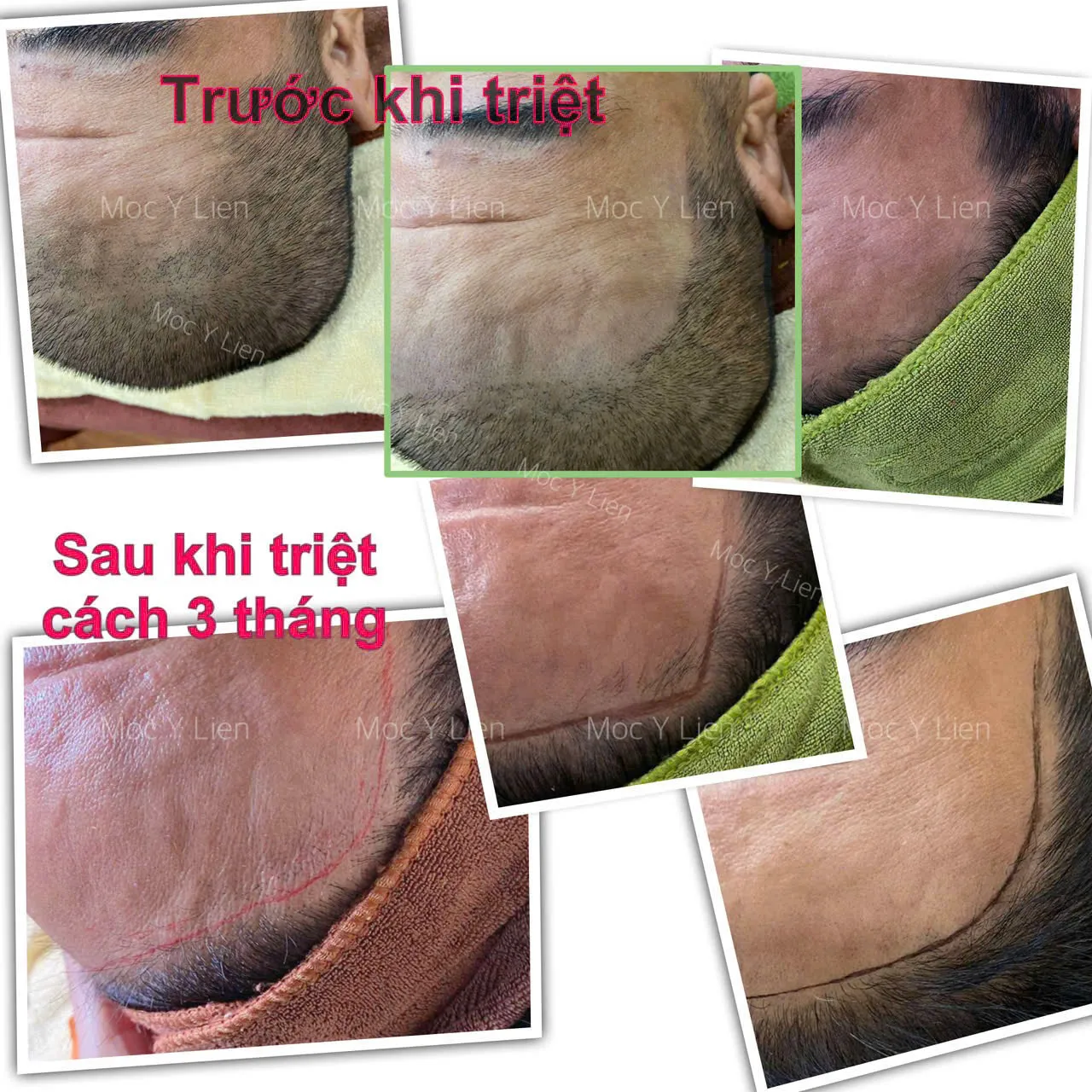 Hình ảnh minh họa triệt tóc trán tạo hình khuôn mặt