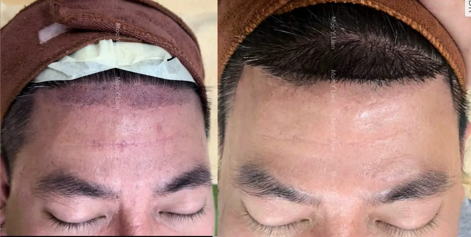 Triệt tóc vĩnh viễn bằng công nghệ cao tại thẩm mỹ viện